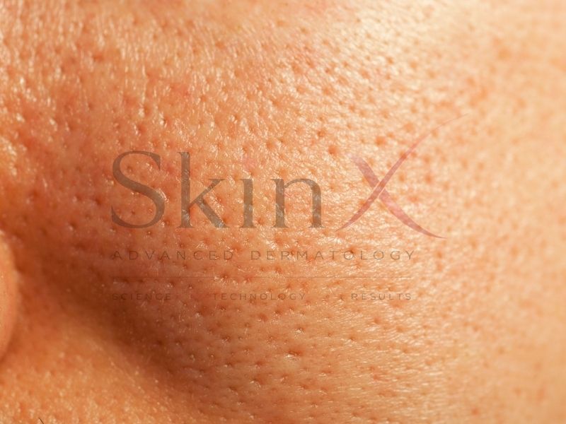 Da sau laser hoặc bị khô sạm cần 1 giải pháp phục hồi chuyên sâu 